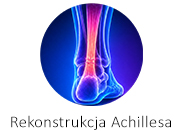Rekonstrukcja Achillesa